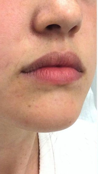 Lip Enhancement Before & After Patient #11329
