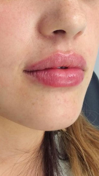 Lip Enhancement Before & After Patient #11329