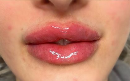 Lip Enhancement Before & After Patient #11330