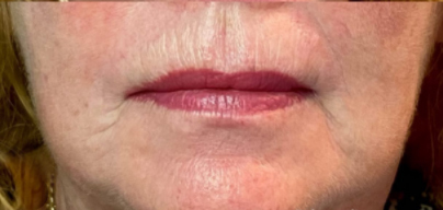 Amalian Fillers Before & After Patient #11272