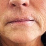 Lip Enhancement Before & After Patient #11318