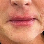 Lip Enhancement Before & After Patient #11318