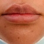 Lip Enhancement Before & After Patient #11321