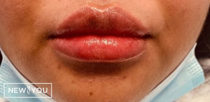 Lip Enhancement Before & After Patient #11321