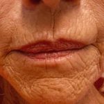 Lip Enhancement Before & After Patient #11322