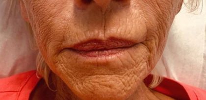 Lip Enhancement Before & After Patient #11322