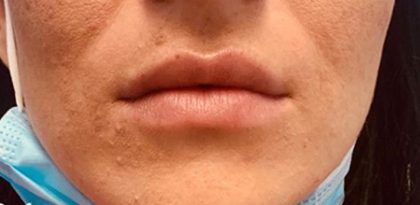 Lip Enhancement Before & After Patient #11323
