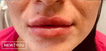Lip Enhancement Before & After Patient #11323