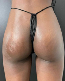 Butt Lift Before & After Patient #11787