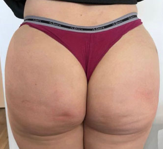 Butt Lift Before & After Patient #11795