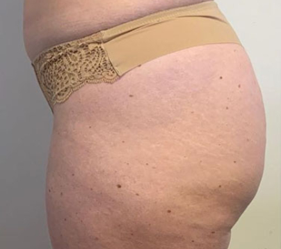 EMBodiSculpt Before & After Patient #11856