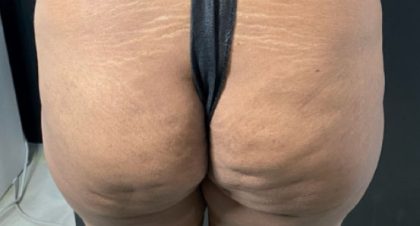 Butt Lift Before & After Patient #11813