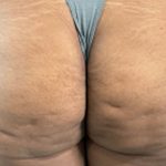Butt Lift Before & After Patient #11813