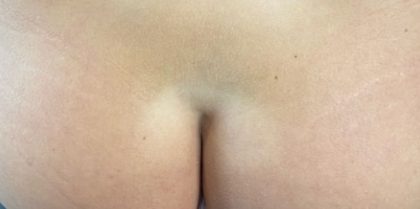 Butt Lift Before & After Patient #11821