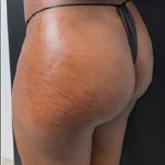 Butt Lift Before & After Patient #11745