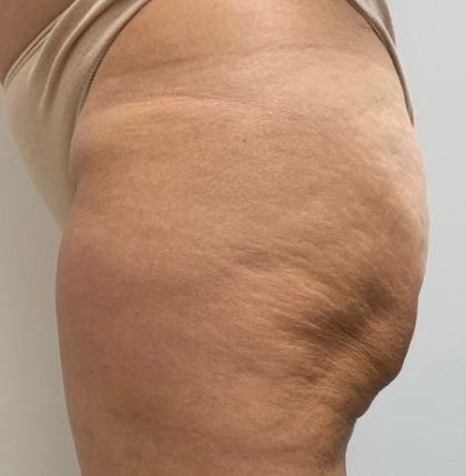 EMBodiSculpt Before & After Patient #11865