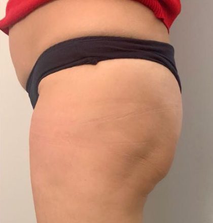 EMBodiSculpt Before & After Patient #11865