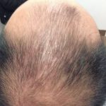 Hair Restoration Before & After Patient #11947