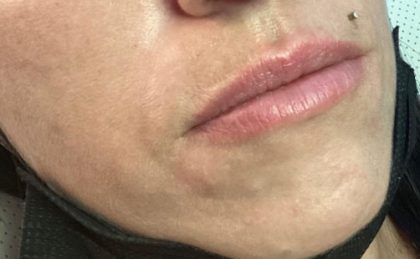 Lip Enhancement Before & After Patient #11930