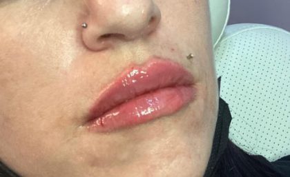 Lip Enhancement Before & After Patient #11930