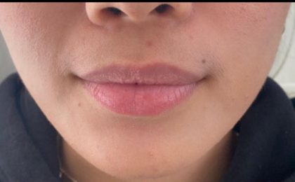 Lip Enhancement Before & After Patient #11935