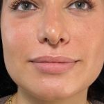 Lip Enhancement Before & After Patient #11940