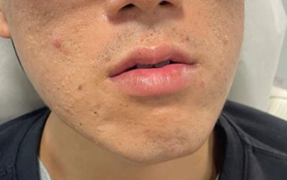 Lip Enhancement Before & After Patient #11899