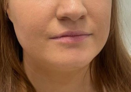 Lip Enhancement Before & After Patient #11910