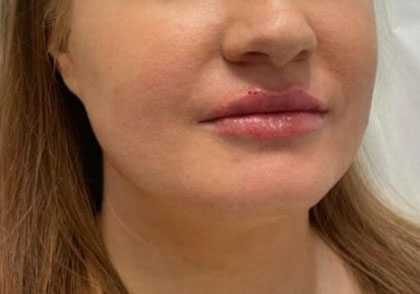 Lip Enhancement Before & After Patient #11910