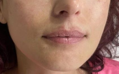 Lip Enhancement Before & After Patient #11915