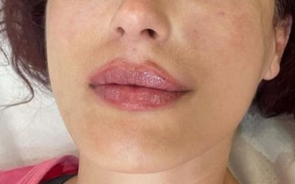 Lip Enhancement Before & After Patient #11915