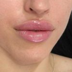 Lip Enhancement Before & After Patient #11922