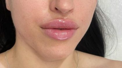 Lip Enhancement Before & After Patient #11922