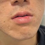 Lip Enhancement Before & After Patient #12111