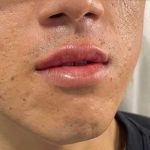 Lip Enhancement Before & After Patient #12111
