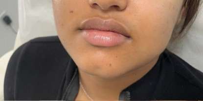 Lip Enhancement Before & After Patient #12112