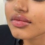 Lip Enhancement Before & After Patient #12112