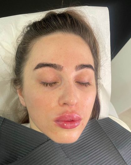Lip Enhancement Before & After Patient #12260