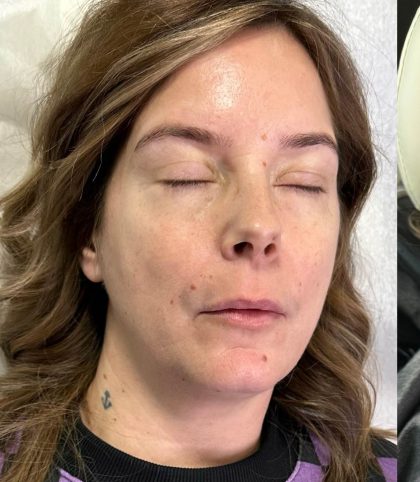 Lip Enhancement Before & After Patient #12261