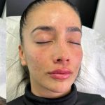 Lip Enhancement Before & After Patient #12165
