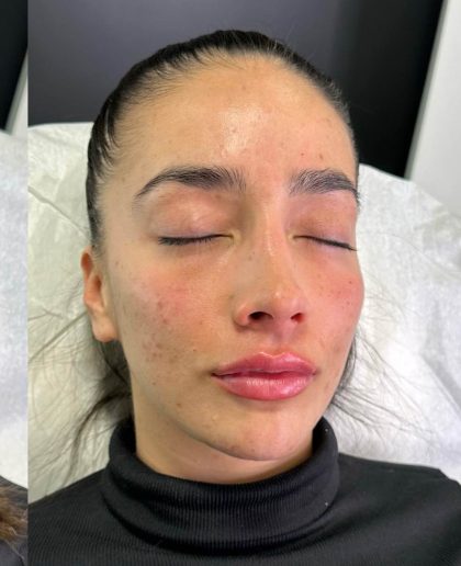 Lip Enhancement Before & After Patient #12165