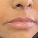 Lip Enhancement Before & After Patient #12113