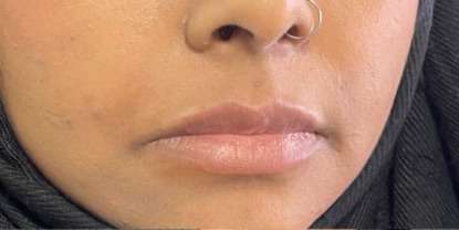 Lip Enhancement Before & After Patient #12113