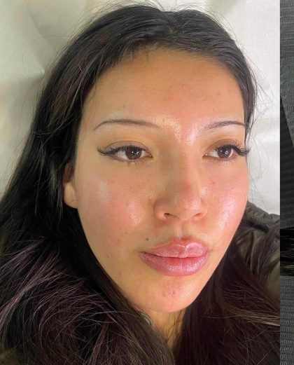 Lip Enhancement Before & After Patient #12167