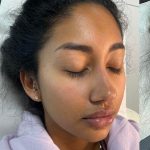 Lip Enhancement Before & After Patient #12168