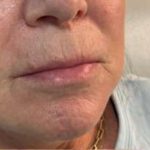 Lip Enhancement Before & After Patient #12115