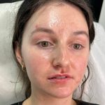 Lip Enhancement Before & After Patient #12171