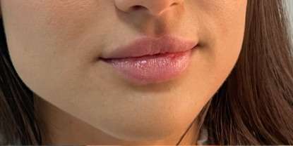 Lip Enhancement Before & After Patient #12116