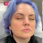 Lip Enhancement Before & After Patient #12172