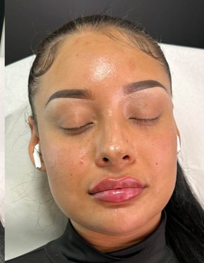 Lip Enhancement Before & After Patient #12173